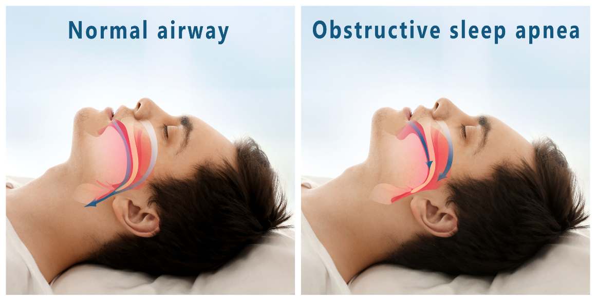 Opciones de tratamiento para la apnea obstructiva del sueño