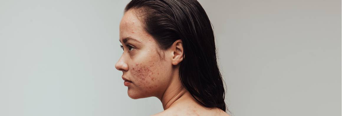 ¿Puede desaparecer mi acné de forma natural?