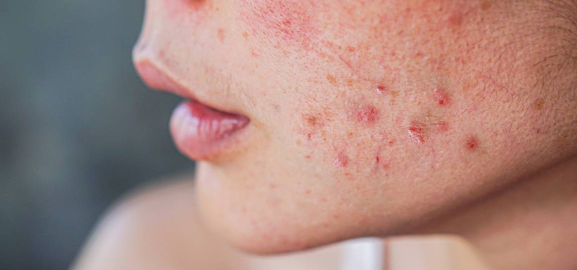 Cómo se deshacen los dermatólogos del acné