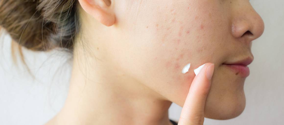 ¿Cómo puedo prevenir el acné de forma natural?