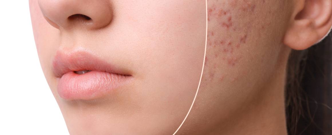 Cuál es la diferencia entre acné y granos