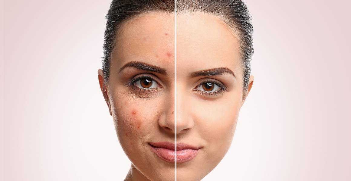 Cuál es la causa principal del acné