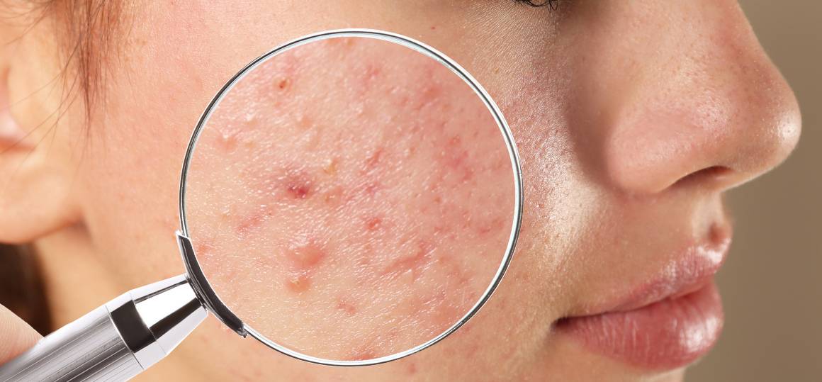 ¿Por qué es tan difícil deshacerse del acné?