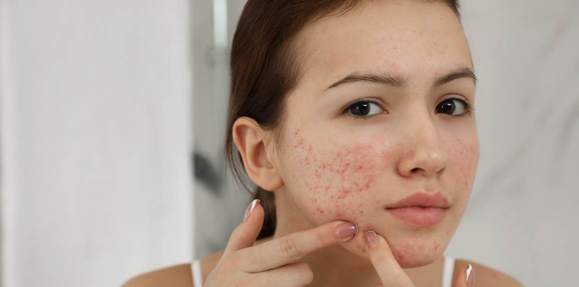 ¿A qué edad se detiene el acné adulto?