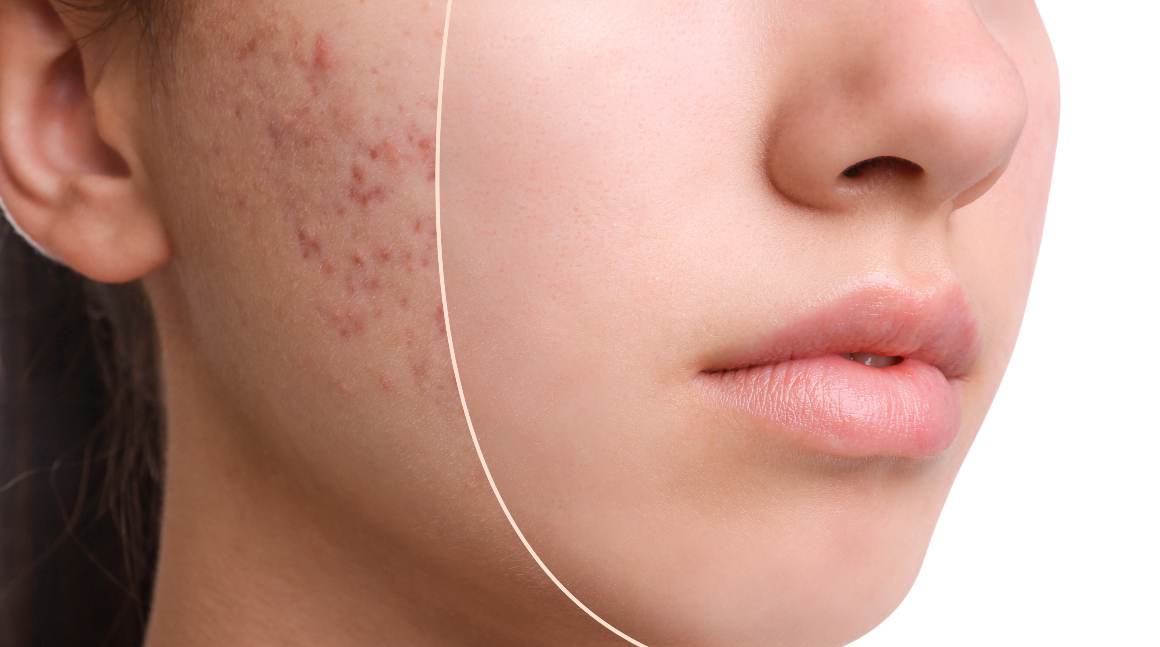 Cuáles son las 5 causas del acné