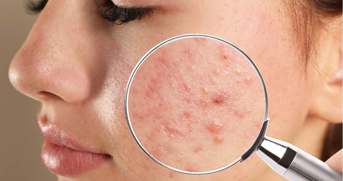¿Cuál es la diferencia entre granos y acné?