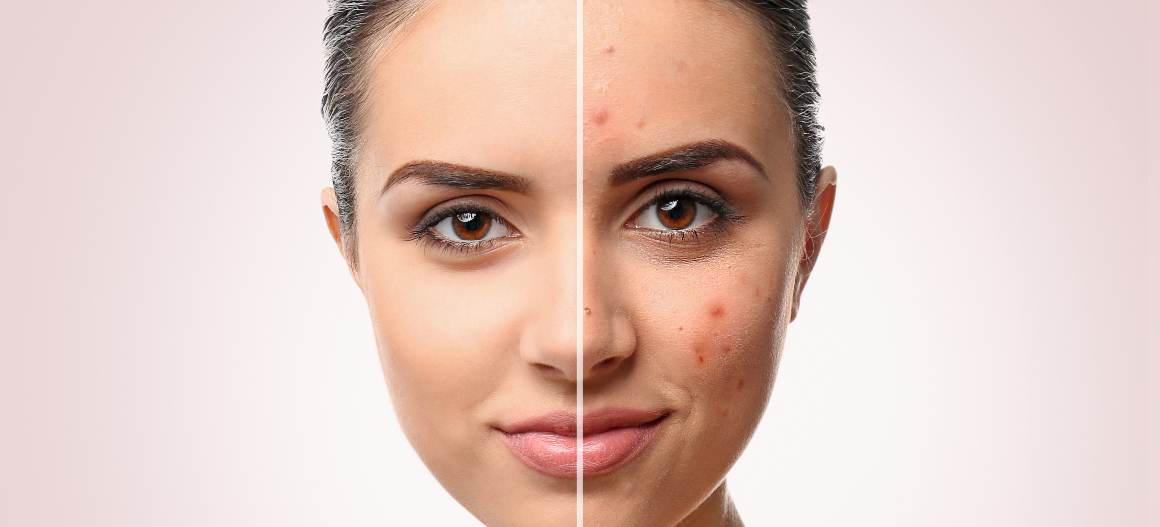 ¿Cómo puedo saber qué tipo de acné tengo?