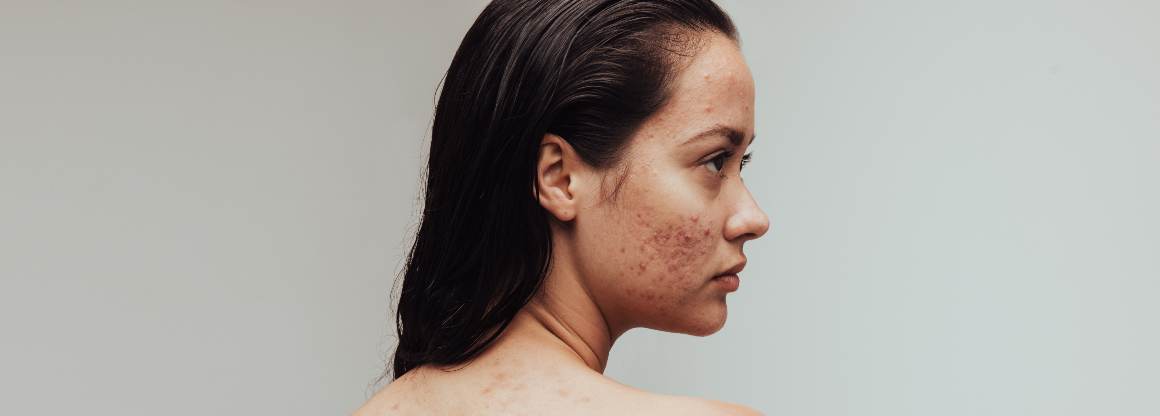 Qué alimentos provocan acné Los 9 alimentos más perjudiciales para el acné