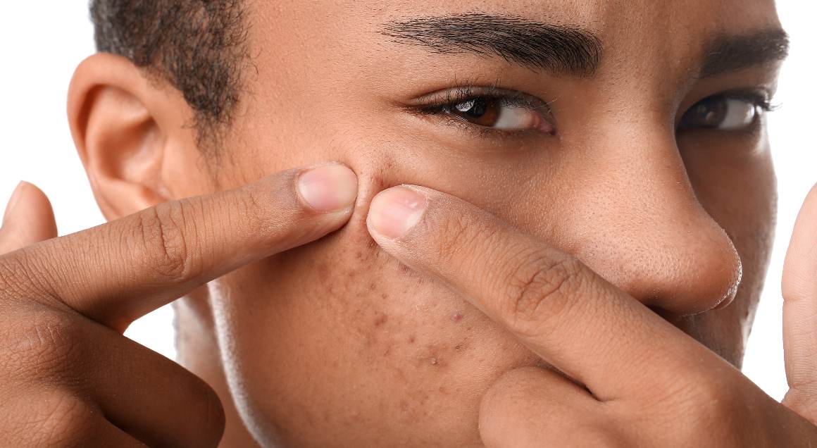 Cuáles son los 2 tipos más comunes de acné
