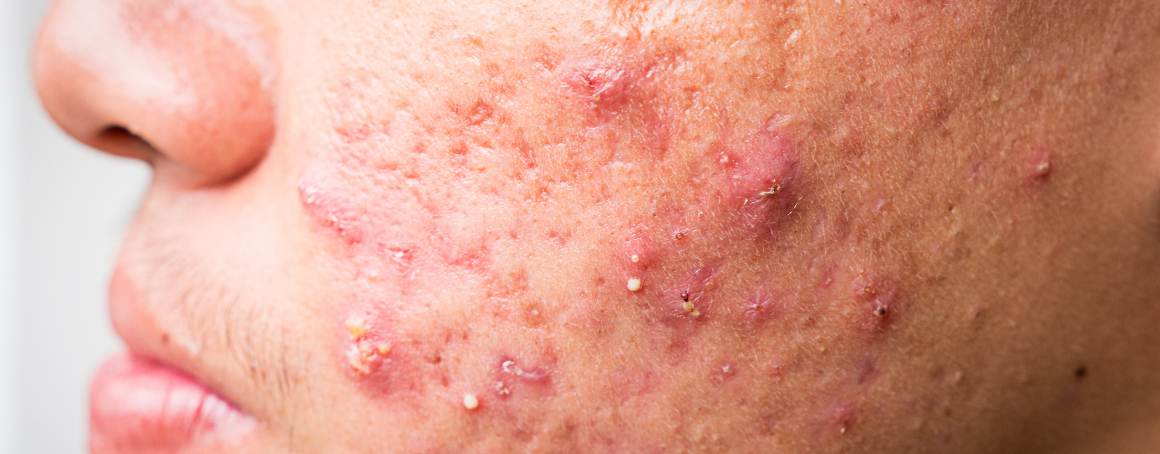 Cuáles son las últimas etapas del acné