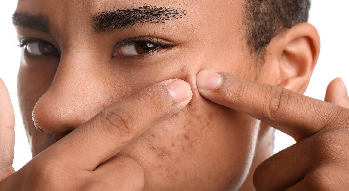 Qué desencadena el acné quístico