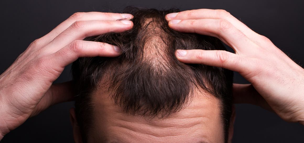 ¿Puede el aceite de CBD ayudar a que crezca el pelo?