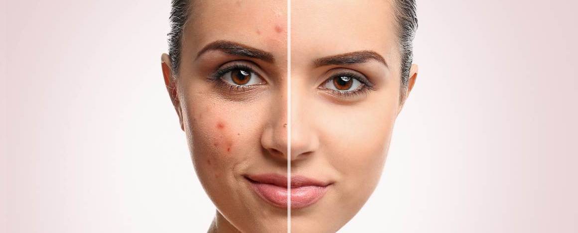 ¿Lavarse la cara empeora el acné?
