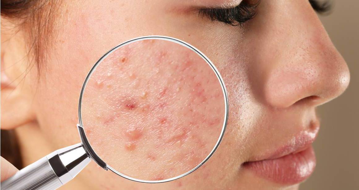 ¿Cuánto tiempo se tarda en eliminar completamente el acné?