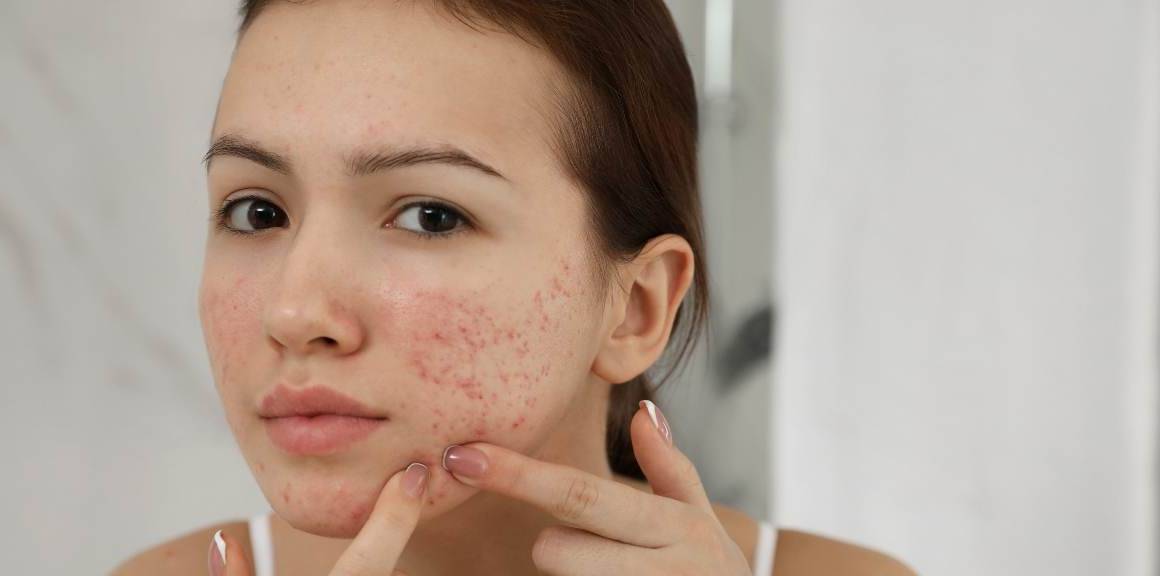 Los sorprendentes beneficios del acné