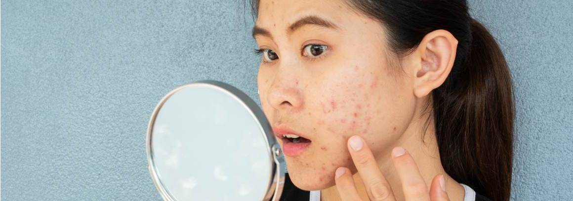 ¿A qué edad es peor el acné?