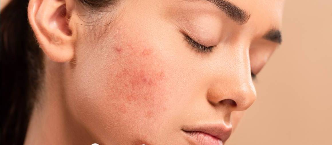 Qué suelen recetar los dermatólogos para el acné