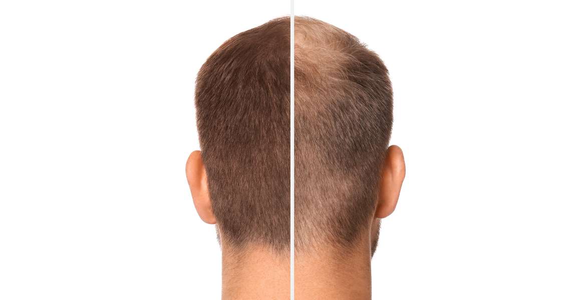 ¿Ayuda el omega-3 al crecimiento del cabello?