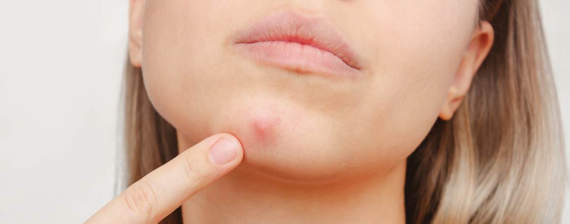 ¿Qué le ocurre al pus de un grano si no lo revienta?