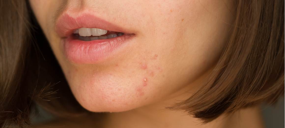 ¿Qué causa el acné en la barbilla?
