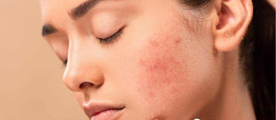 ¿Qué tipo de acné es el más difícil de tratar?