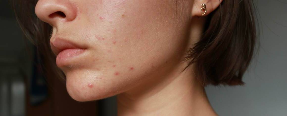 ¿Cómo puedo saber si mi acné es hormonal o por estrés?
