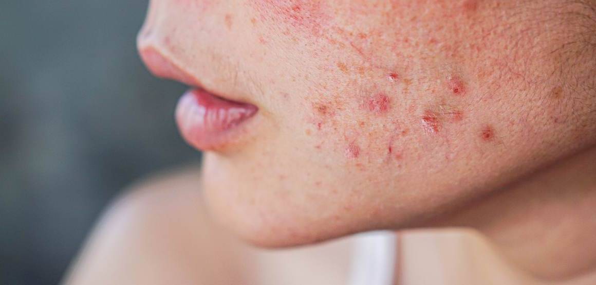 ¿El acné significa que envejece más despacio?