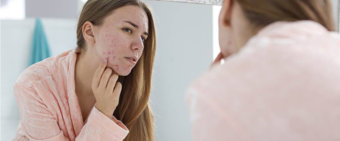 ¿Vuelve el acné después de la doxiciclina?
